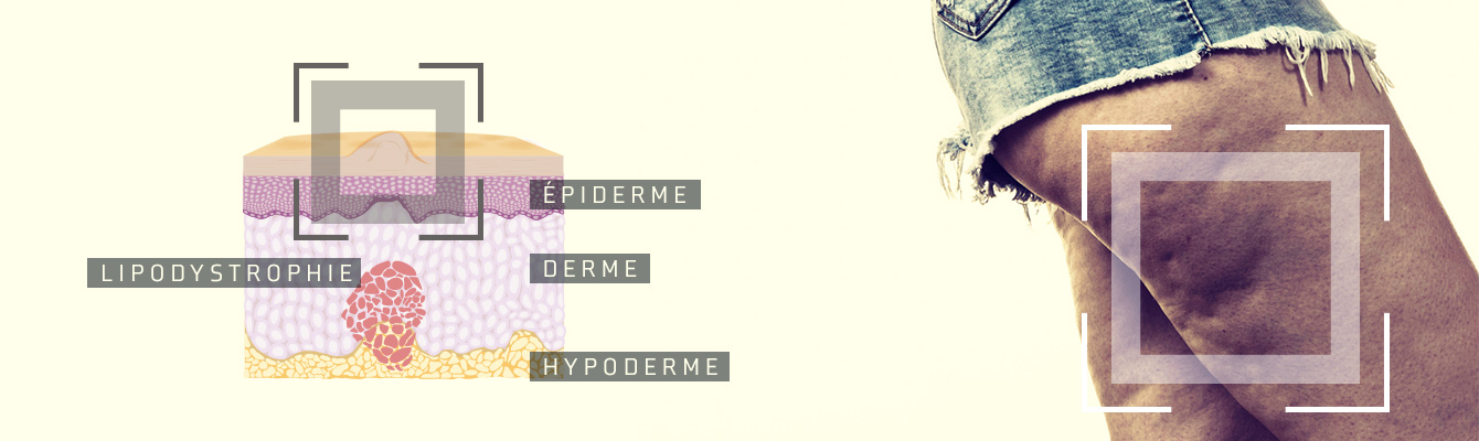 Lipodystrophie : plusieurs origines, une solution Lipodystrophie : plusieurs origines, une solution