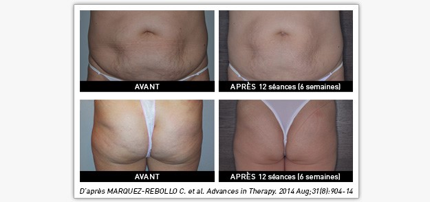 Lipodystrophie soignée par endermologie médical